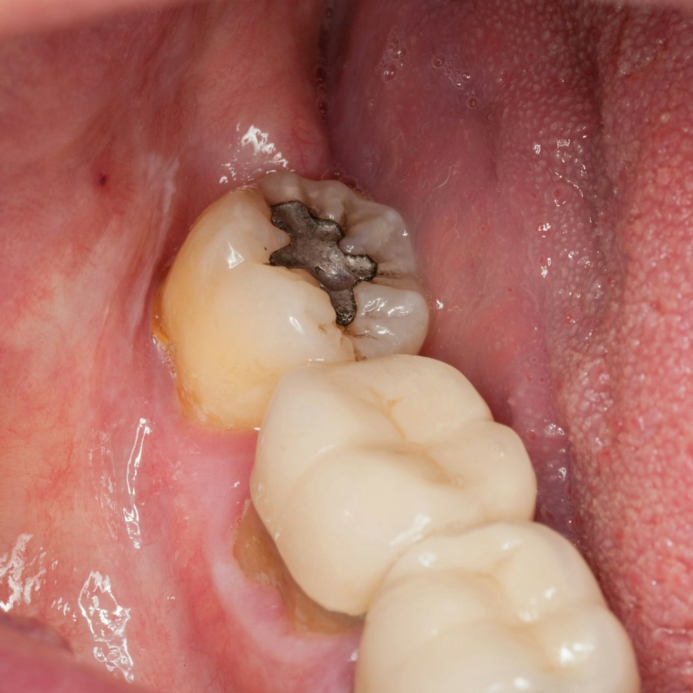 A tooth with a mercury filling