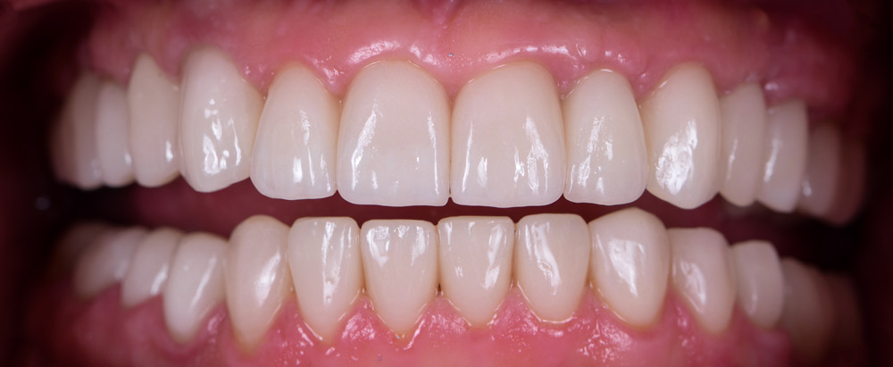 After Dental Crown Placement
