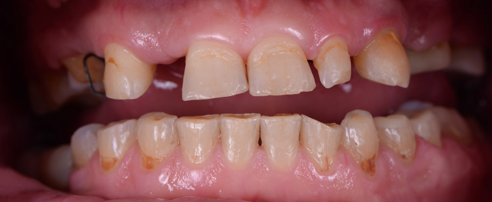Before Dental Crown Placement