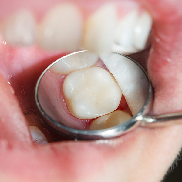 dental filling