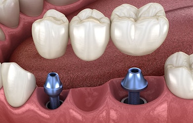Implant-supported bridge