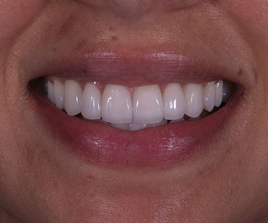 After treatment
