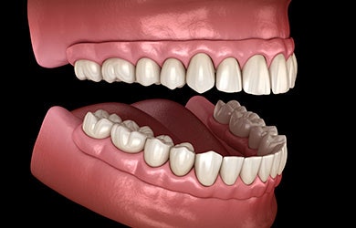 Denture