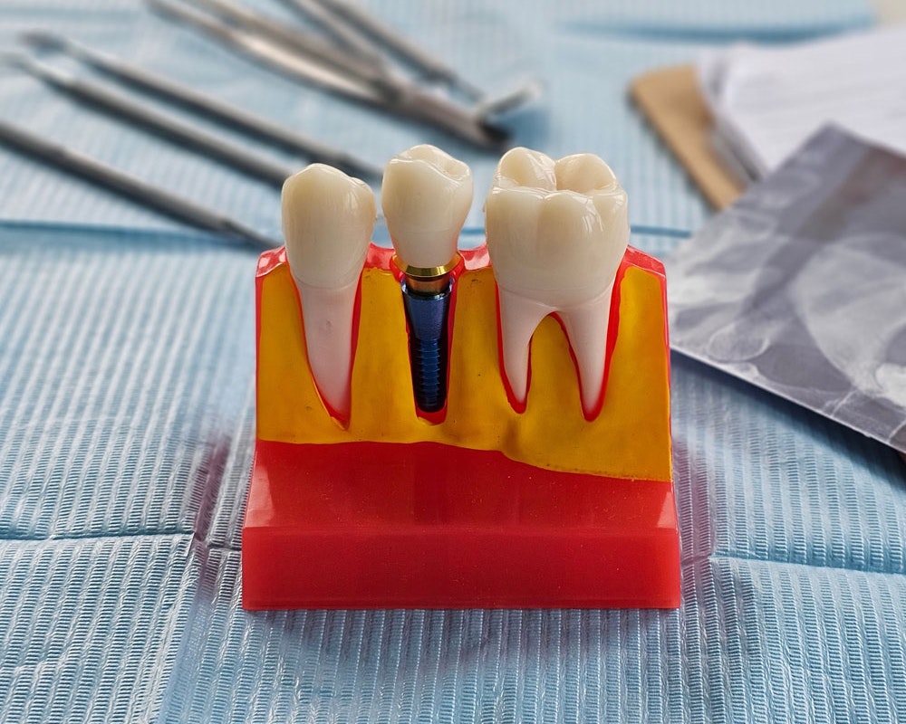 Dental implant in model of jaw