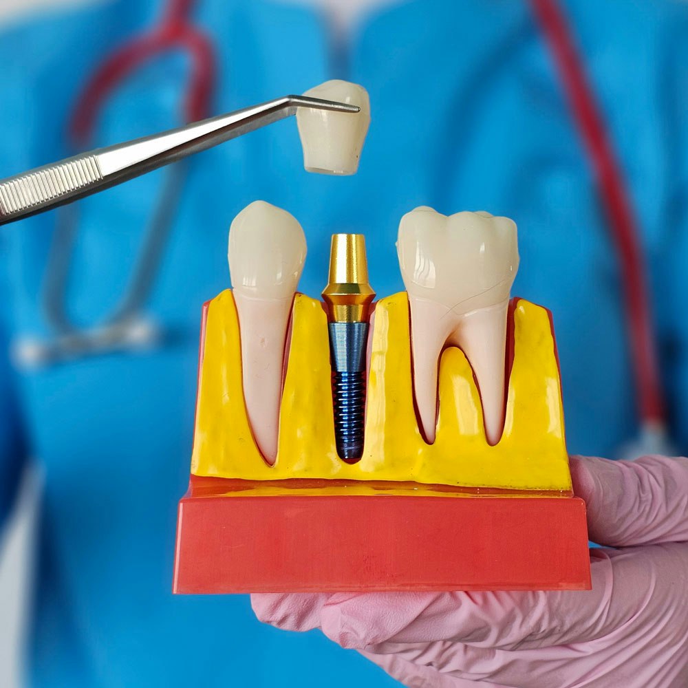 dental implant model and crown