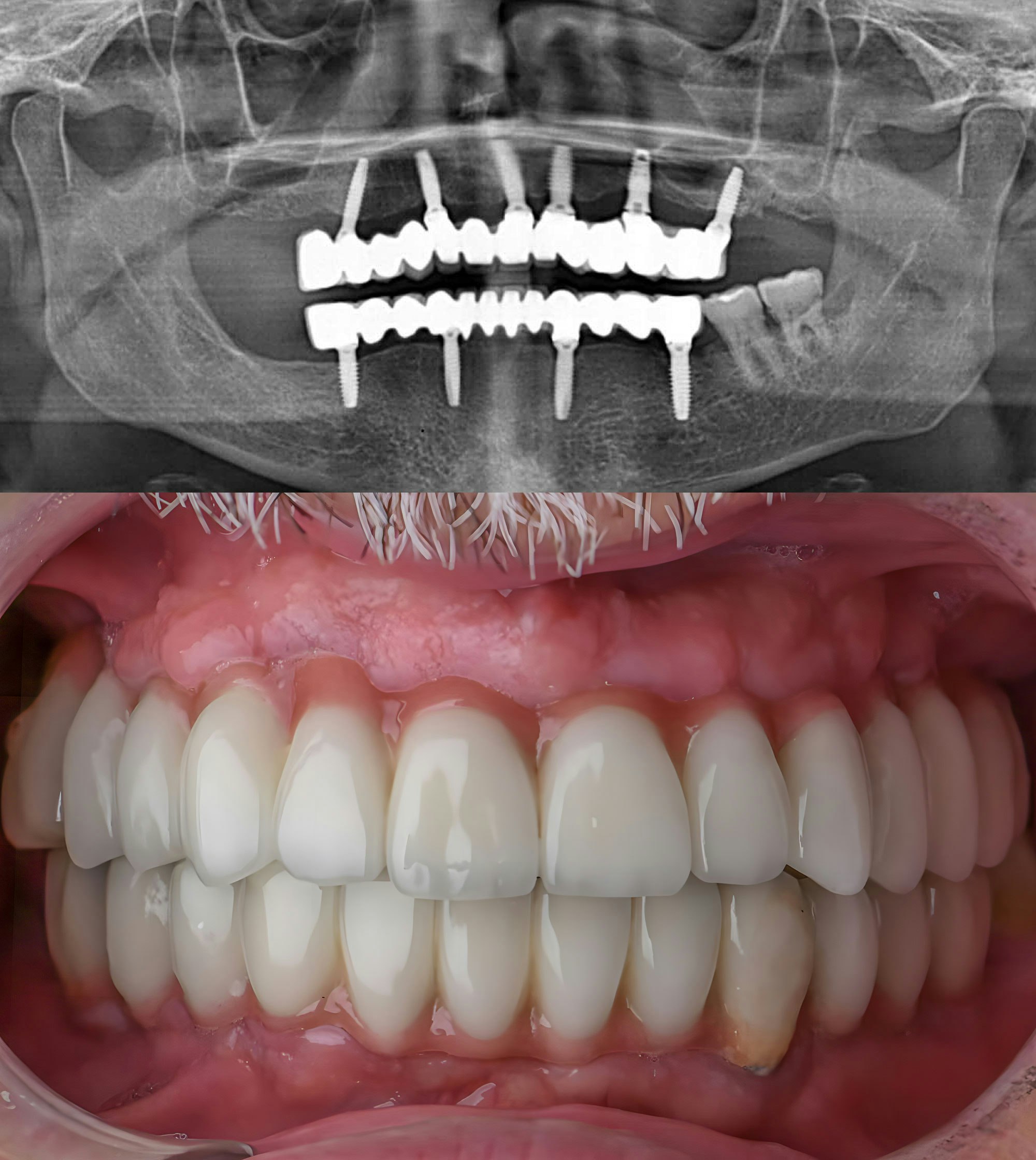 dental implant x-ray and implant-supported dentures in mouth