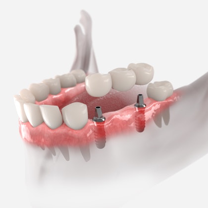 Illustration of an implant-supported bridge