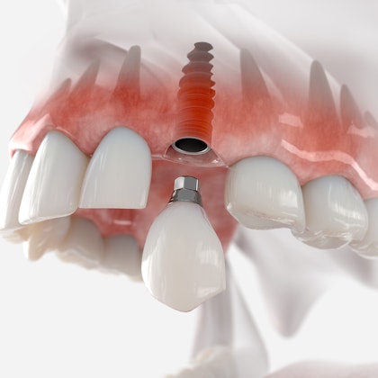 Implant crown illustration