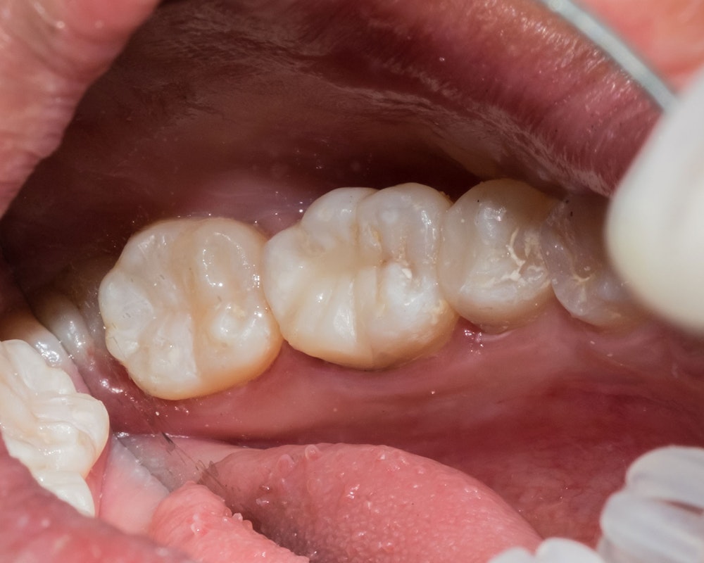 White filling