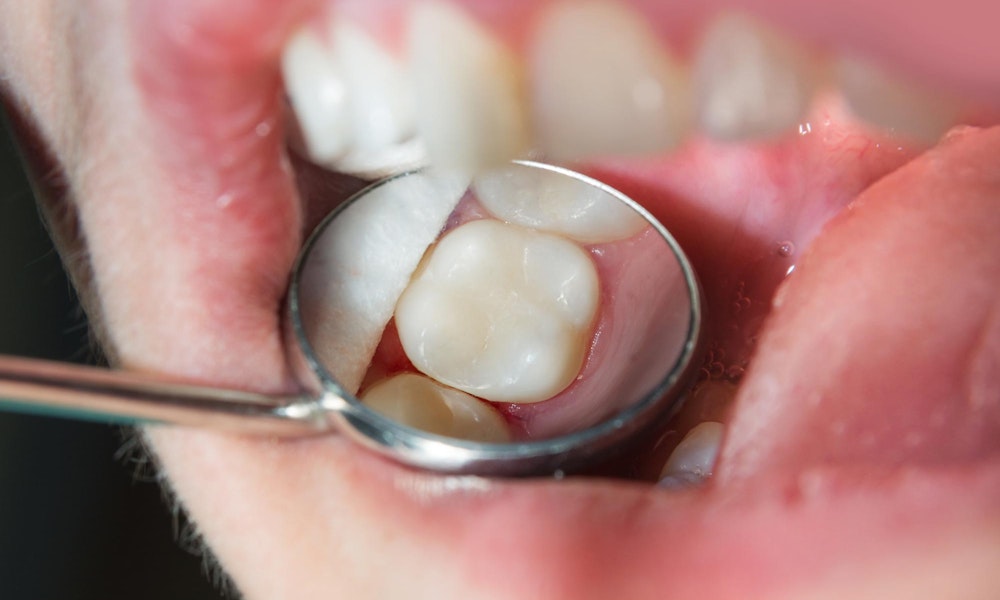 Tooth with filling