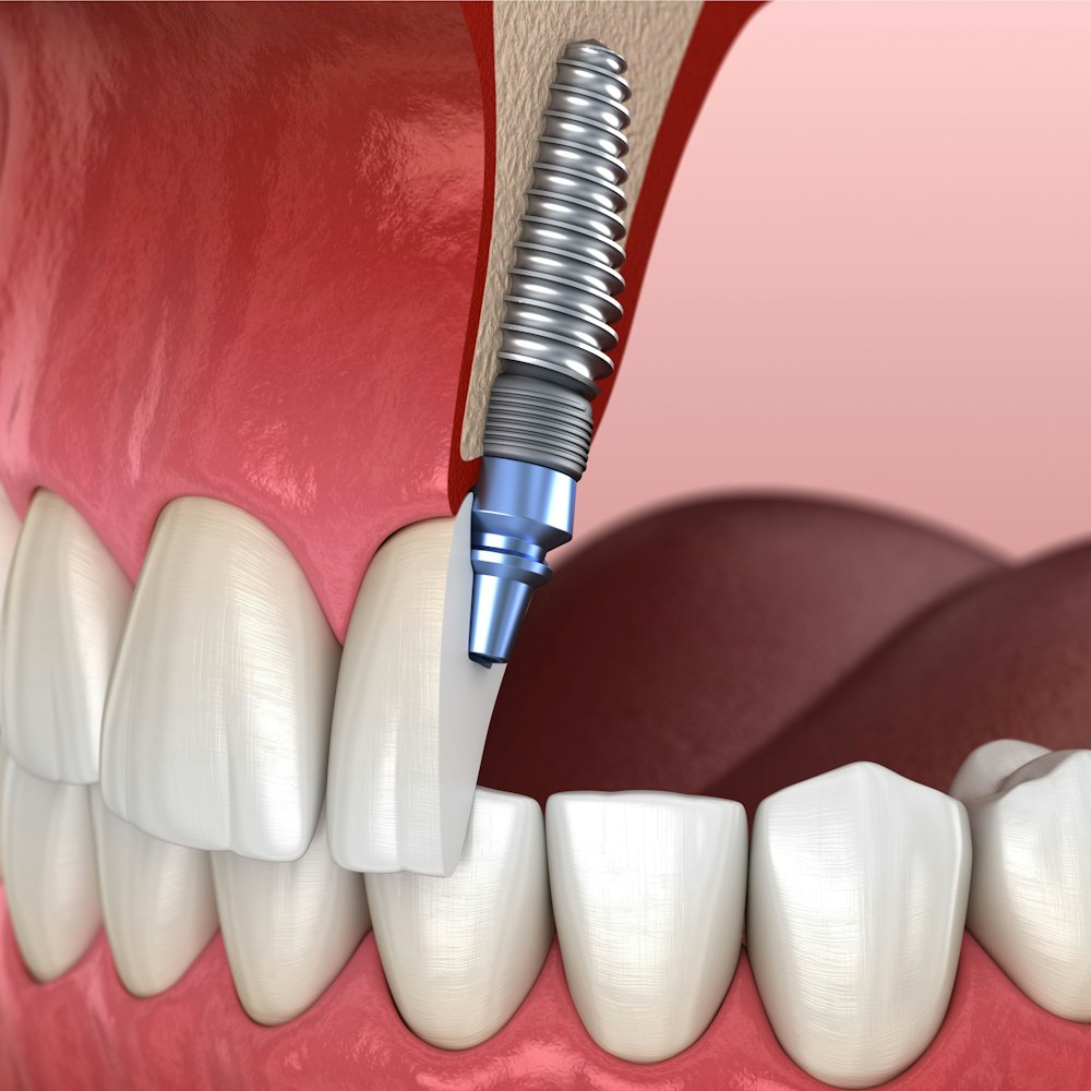 An illustration of an implant-supported crown