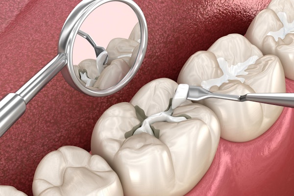Composite Filling