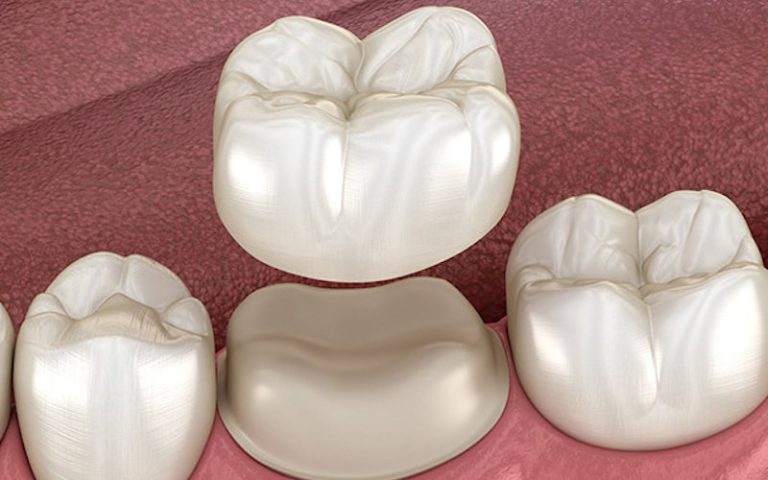 Crowns and Bridges: When a Filling Isn’t Enough