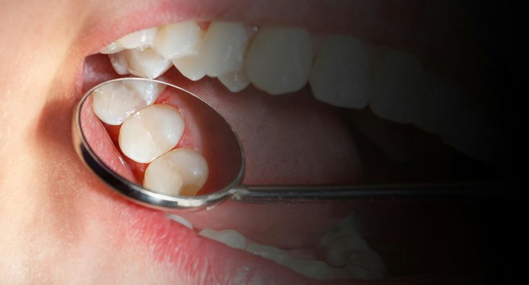 Composite vs. Porcelain vs. Gold: Choosing the Right Filling Material