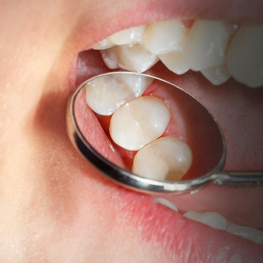 Why We Stopped Using Metal Amalgam Fillings