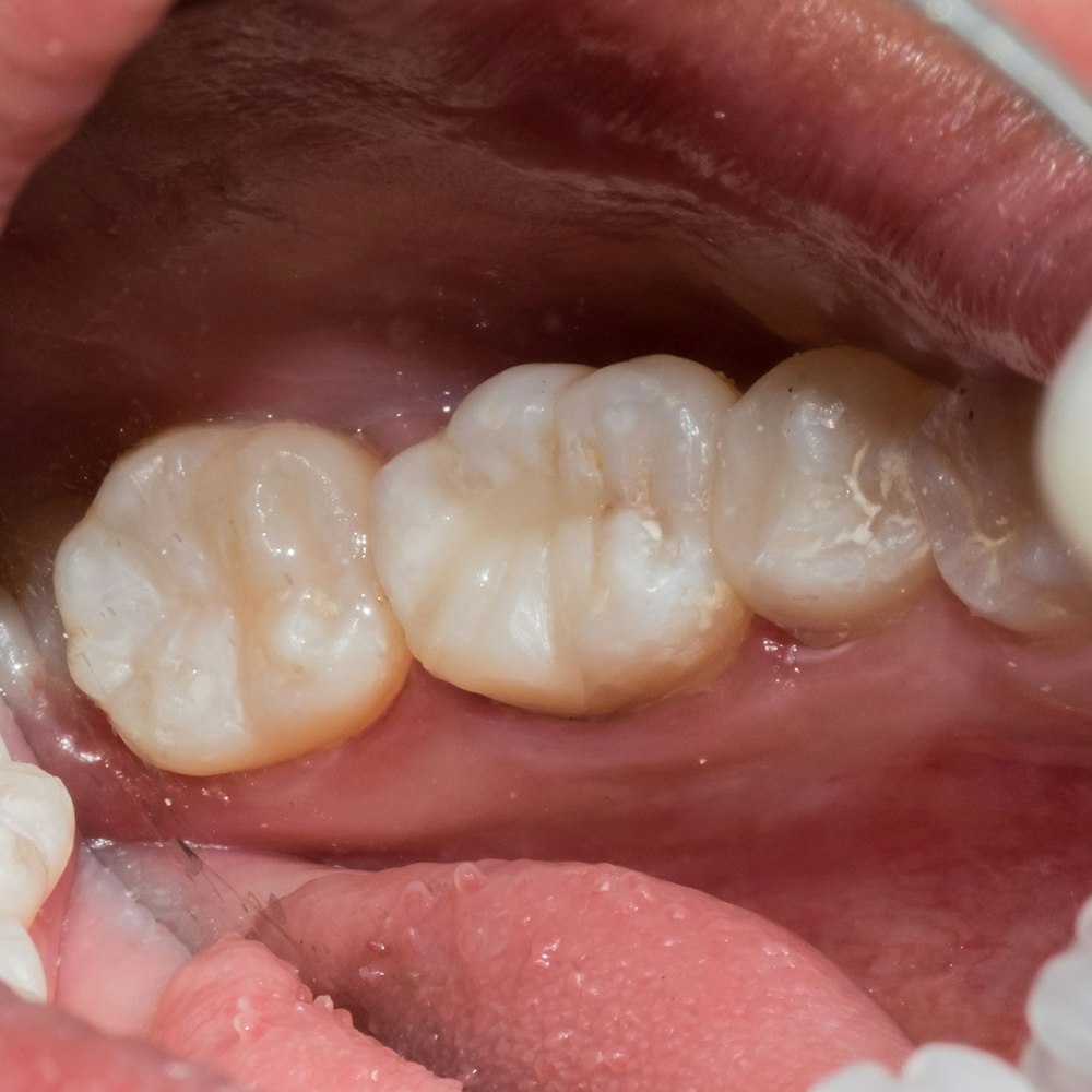 In-Office vs. At-Home Whitening: Which Fits Your Timeline?
